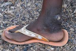 Guinea worm, Jon Warren for World Vision